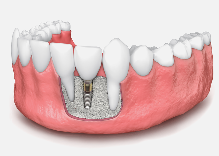 bone graft for dental implant model Lafayette IN